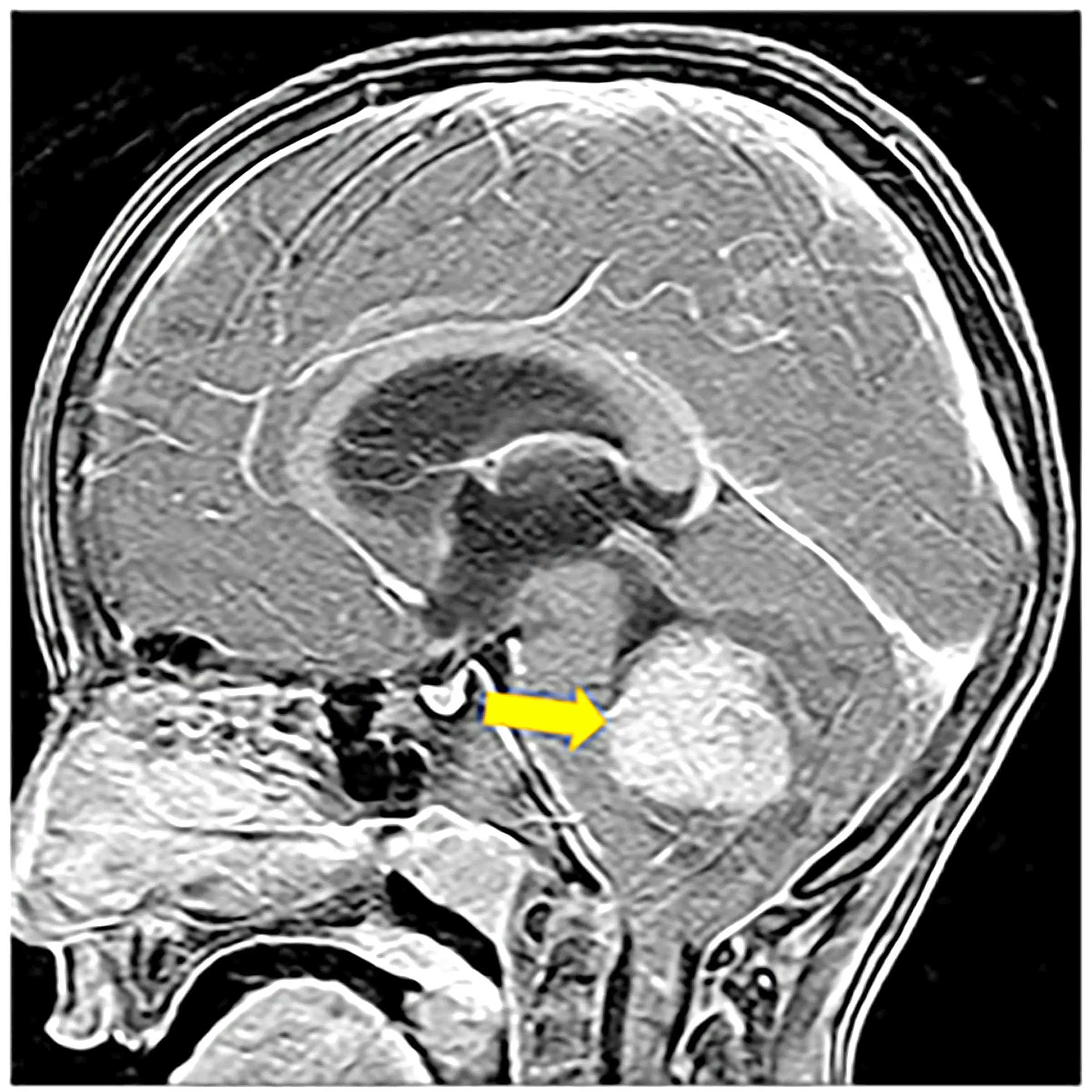 MRI image of a brain tumor