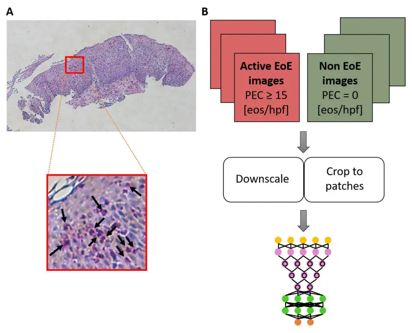 An image example of a full-size H&E-stained esophageal biopsy slide from a patient with active EoE as well as schematics of the platform used to train a deep convolutional neural network (DCNN).
