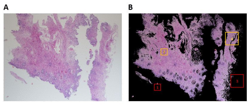 A typical image taken at 80X magnification of a hematoxylin and eosin stained esophageal biopsy section obtained from an individual with active EoE, side-by-side with the same image after background removal with an illustration of tissue coverage criteria per patch size to meet the threshold for inclusion in training or validation sets.
