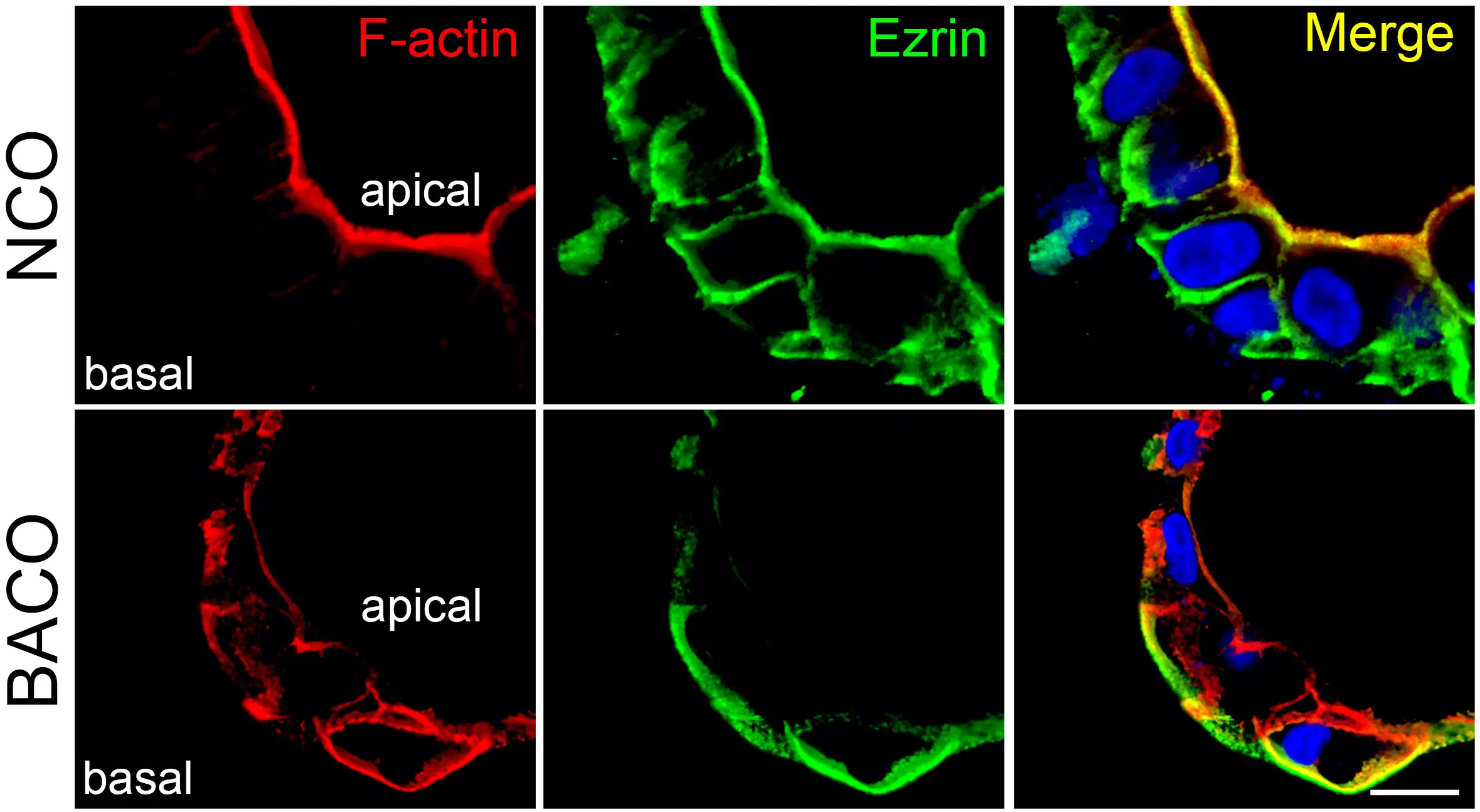 6-panel image depicts cell structures in red and green to illustrate differences in healthy vs diseased organoids used to study biliary atresia