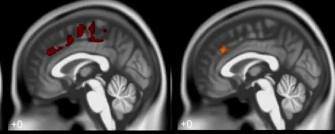 Two brain MRI scans side by side