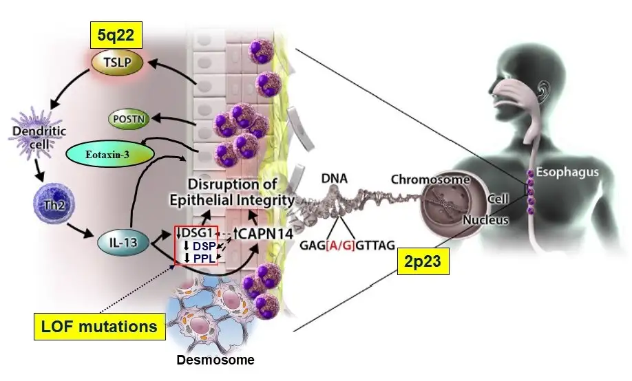 Diagram explaining two gene variants at work in familial EoE