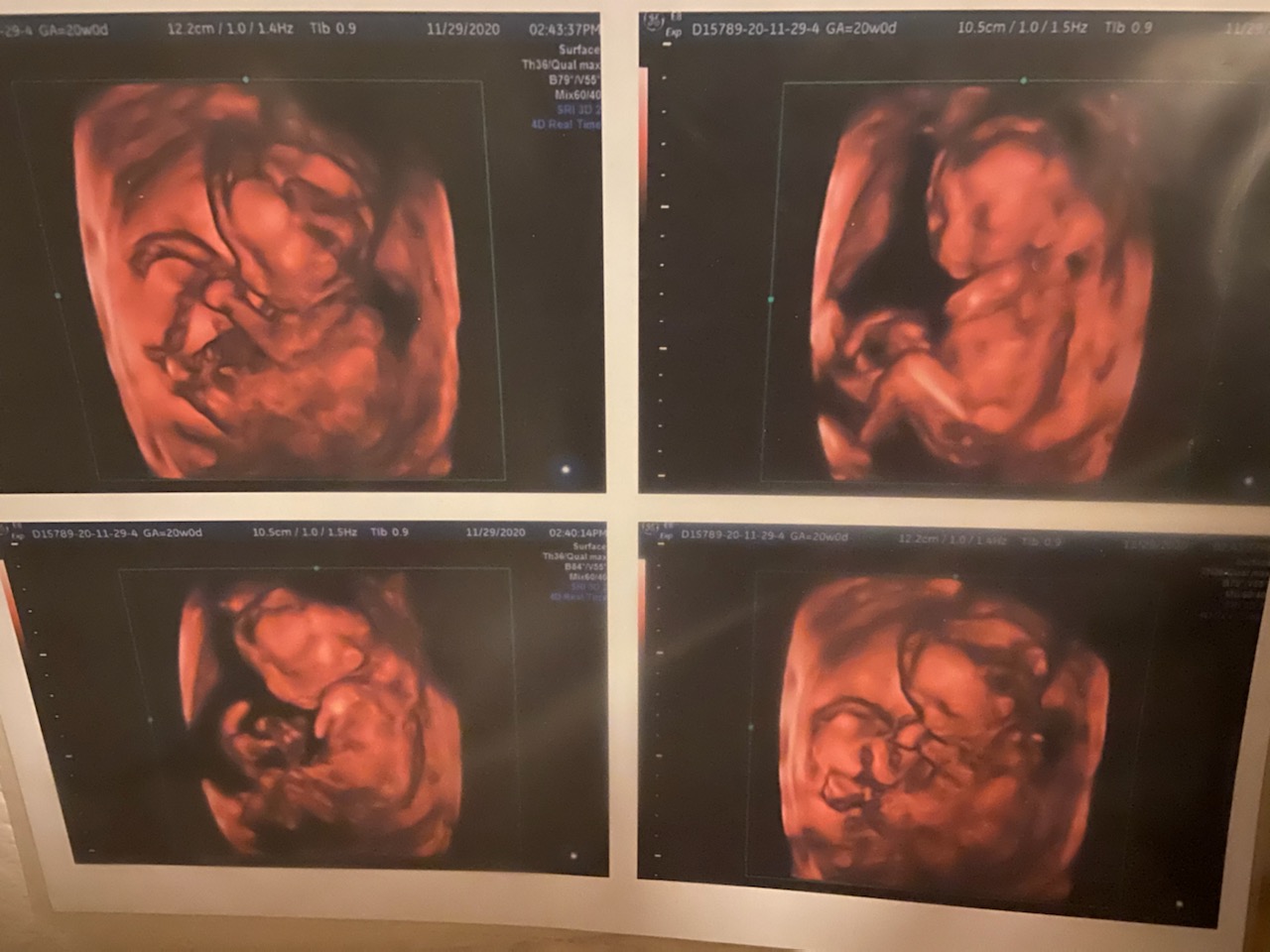 A set of four ultrasound images taken during Tinamarie's pregnancy with Thessa
