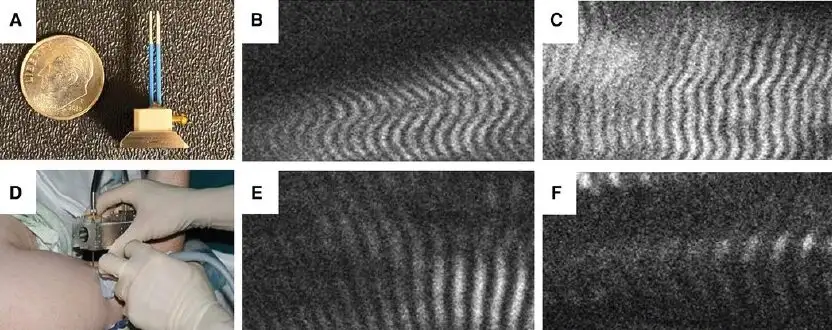(A) Microendoscopic probe consisting of two 20-guage needles inserted into biceps muscle while mounted on a handheld microscope (B) allows visualization of sarcomeres in real time as depicted from the unaffected and affected muscles in a subject with BPBI (C,D, respectively) and a subject with CP (E,F, respectively).