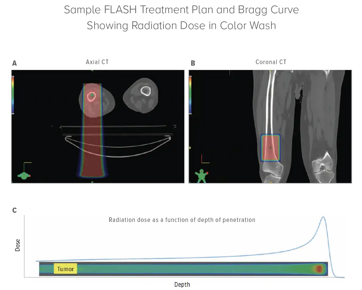 A) Axial computed tomography (CT) through a lesion treated in the right distal femur. B) Coronal CT through the same lesion. C) The radiation dose, drawn as a blue line, as a function of depth of penetration into the body for FLASH delivery with a 250-MeV transmission beam. The radiation dose is represented on the vertical axis, with depth of penetration into the body on the horizontal axis. The yellow box on the aqua-colored bar represents the position of the tumor in the radiation field, and the brighter red spot is the location of the increased dose at the Bragg peak, occurring outside of the patient’s body. In all panels, darker red color indicates higher dose.