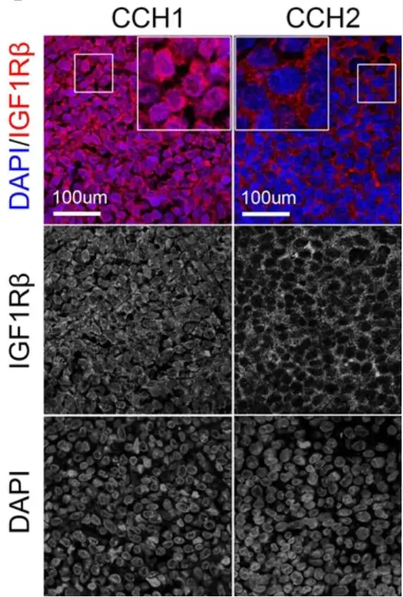 Microscopic slide images showing differences between two subtypes of Ewing sarcoma tumors