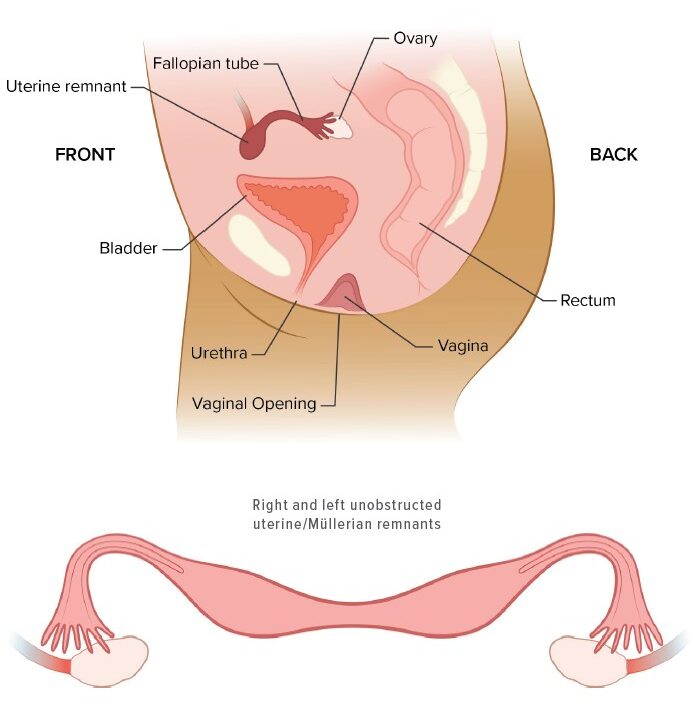 Illustration of vaginal shortening and some of the other birth defects that can occur for those born with Müllerian agenesis, also known as Mayer-Rokitansky-Küster-Hauser (MRKH) syndrome.