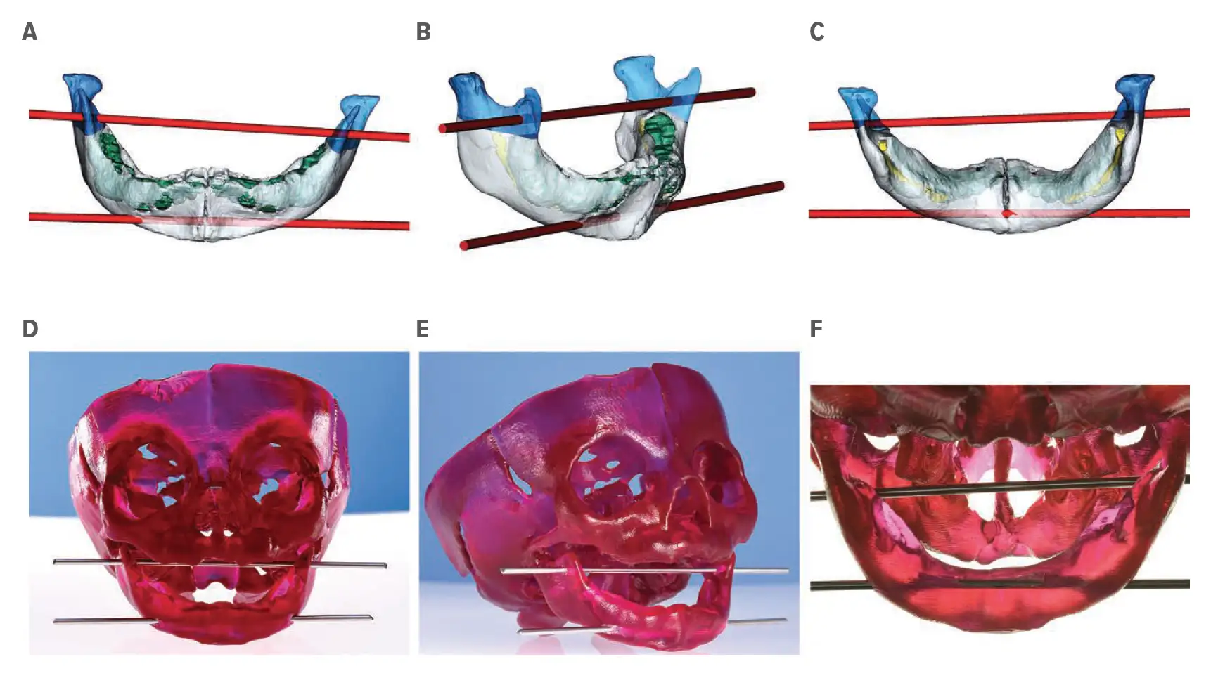 Segmented CT images (A–C) and photographs (D–F) of a 3D-printed model demonstrating optimal UP and LP position. The UP is placed in the mandibular ascending ramus, within the base of the coronoid process. Care is taken to allow enough room between the pin and the most distal tooth bud for the osteotomy to be performed (along the blue/white junction in A–C). The LP is placed near the lower border of the mandibular body, inferior to all radiologically visible tooth buds, passing through all four mandibular cortices.