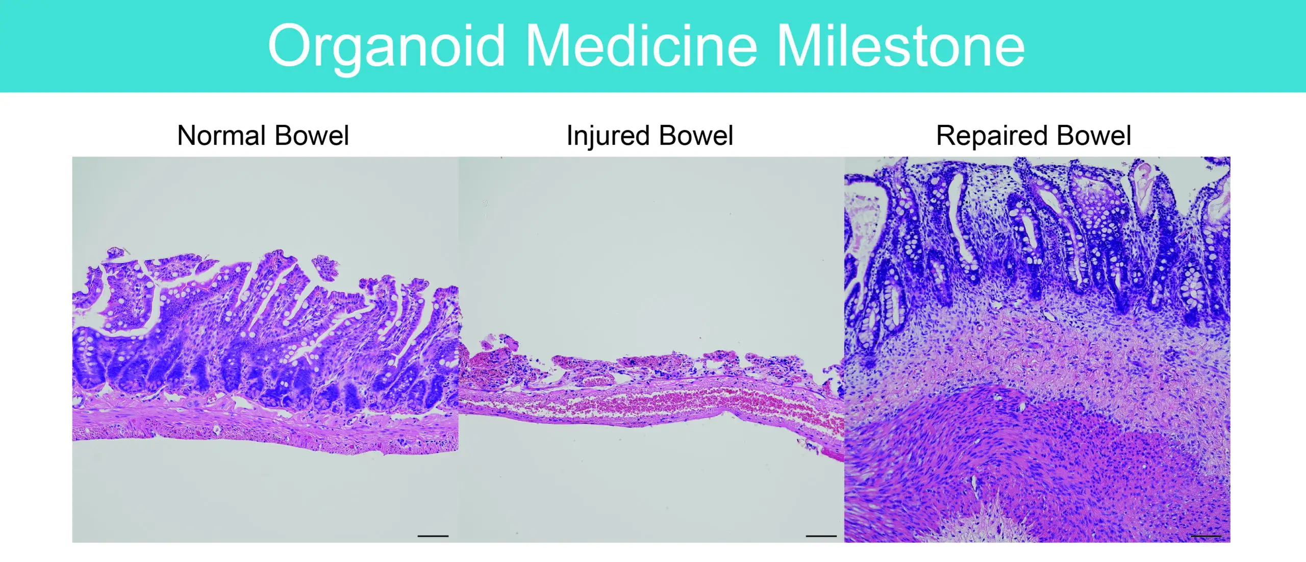 experts at Cincinnati Children’s became the world’s first research team to successfully repair damaged intestine using a cell therapy based on lab-grown organoid tissue. With human cells involved, the repaired bowel (right) also thickened.