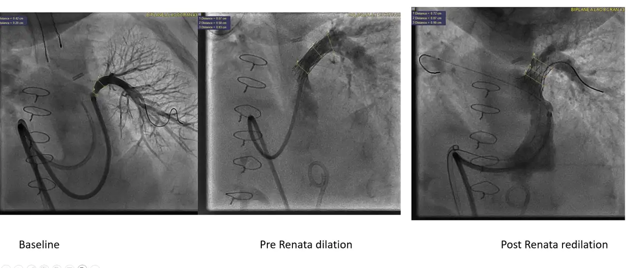 Scans show the placement of the Renata Minima stent in a coronary artery.