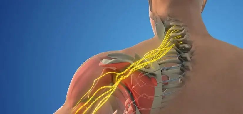 graphic of nerves lit up against muscles to illustrate a brachial plexus injury