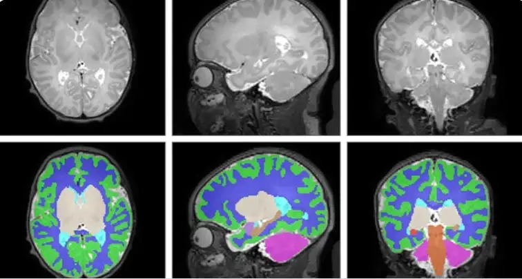 A 6-panel collection of brain images that show differences in brain volumes between opioid exposed newborns and non-exposed newborns.