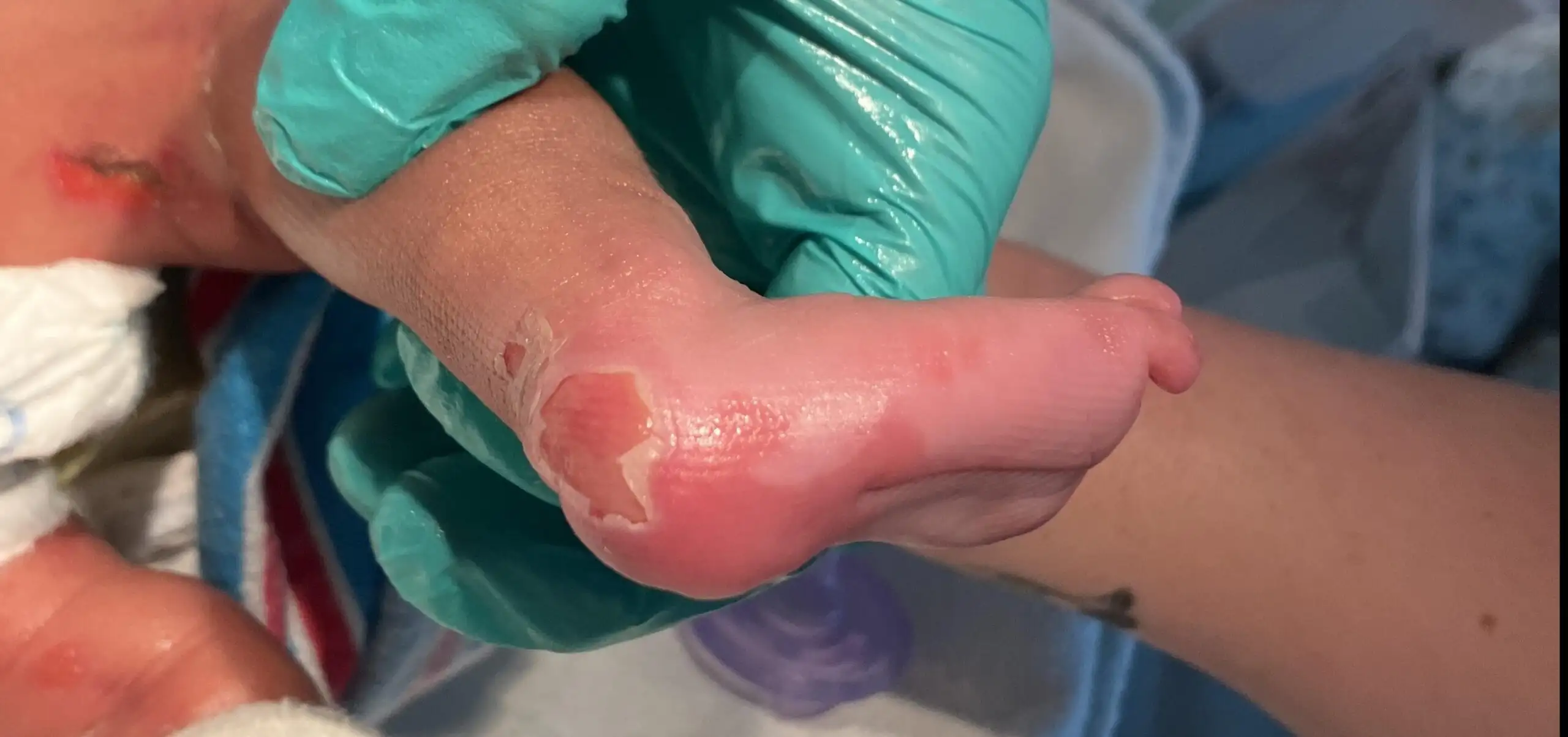 Unified Care for Fragile-Skin Patients - Research Horizons