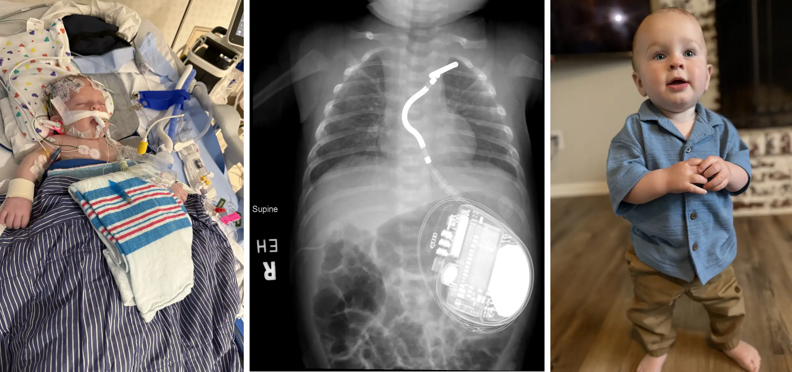 Speed, Expertise and Advanced Technology Combine to Save an Infant’s Heart