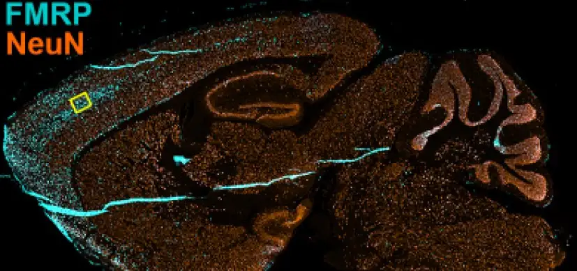 Gene Therapy Restores Key Fragile X Traits in Preclinical Study